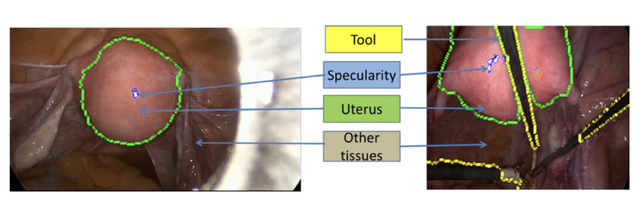 Live image parsing in uterine laparoscopy thumbnail